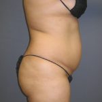 Liposuction Female Before & After Patient #1108