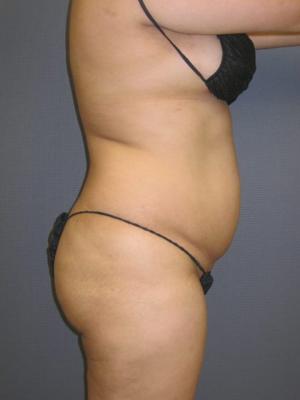 Liposuction Female Before & After Patient #1108