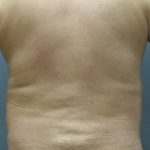 Male Liposuction Before & After Patient #1884