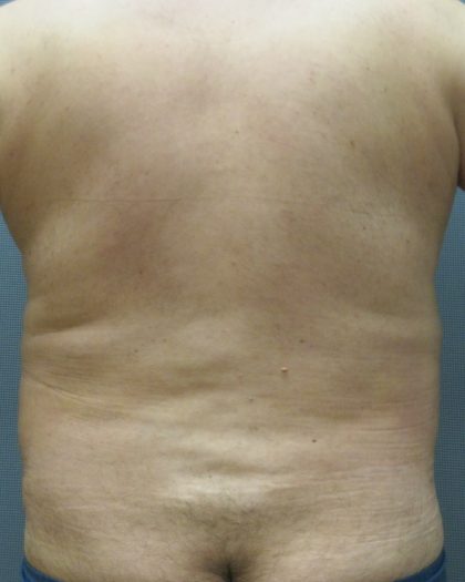 Male Liposuction Before & After Patient #1884