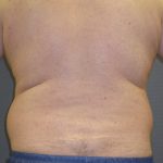 Male Liposuction Before & After Patient #1884