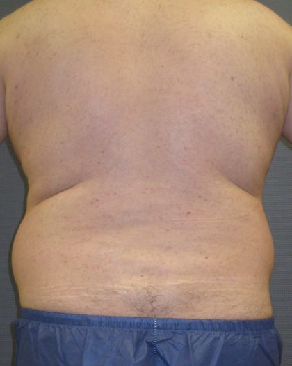 Male Liposuction Before & After Patient #1884