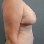 Mastopexy (Breast Lift) Before & After Patient #763
