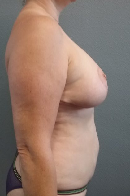 Mastopexy (Breast Lift) Before & After Patient #763