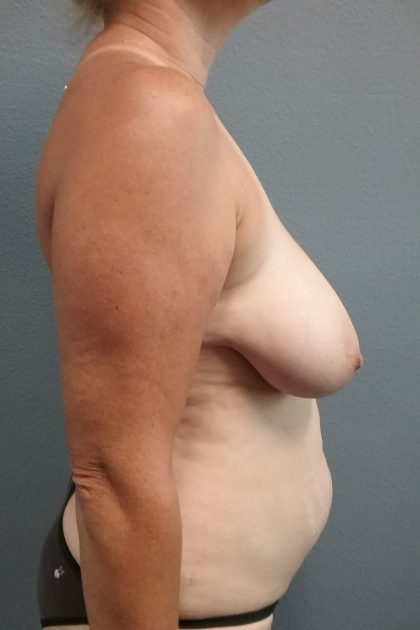 Mastopexy (Breast Lift) Before & After Patient #763