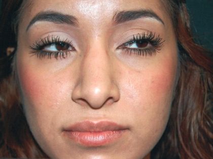 Revision Rhinoplasty Before & After Patient #331
