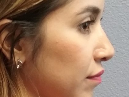 Revision Rhinoplasty Before & After Patient #331