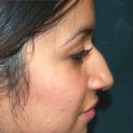 Revision Rhinoplasty Before & After Patient #331