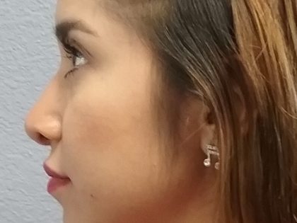Revision Rhinoplasty Before & After Patient #331