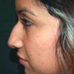 Revision Rhinoplasty Before & After Patient #331