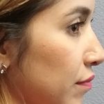 Rhinophyma Before & After Patient #1400