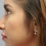 Rhinophyma Before & After Patient #1400