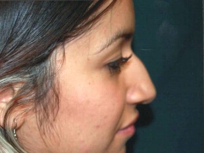 Rhinoplasty Before & After Patient #605