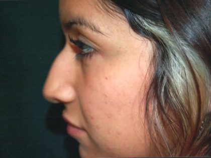 Rhinoplasty Before & After Patient #605