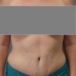 Abdominoplasty Before & After Patient #2222