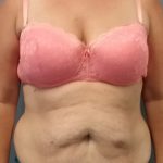Abdominoplasty Before & After Patient #2222