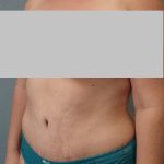 Abdominoplasty Before & After Patient #2222