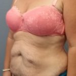 Abdominoplasty Before & After Patient #2222