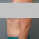 Abdominoplasty Before & After Patient #2222
