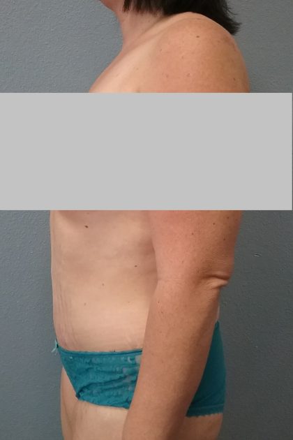 Abdominoplasty Before & After Patient #2222