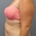 Abdominoplasty Before & After Patient #2222