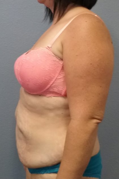 Abdominoplasty Before & After Patient #2222
