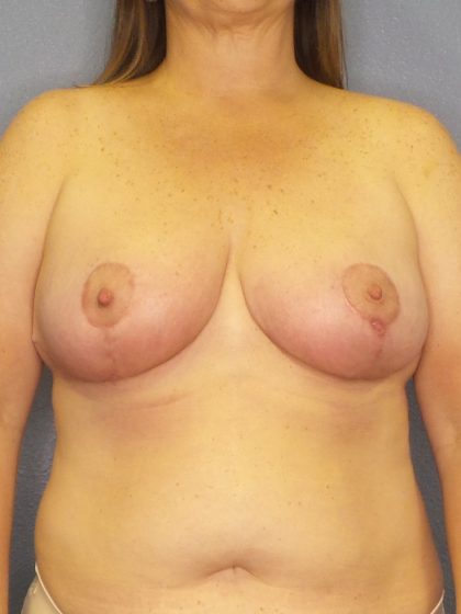 Mastopexy (Breast Lift) Before & After Patient #706