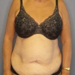 Abdominoplasty Before & After Patient #2022