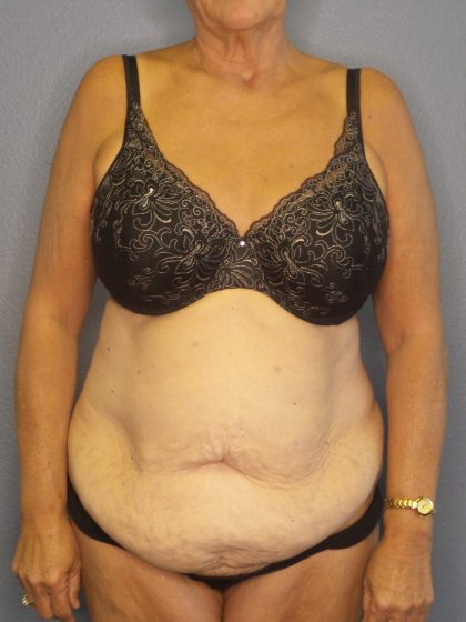 Abdominoplasty Before & After Patient #2022