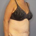 Abdominoplasty Before & After Patient #2022