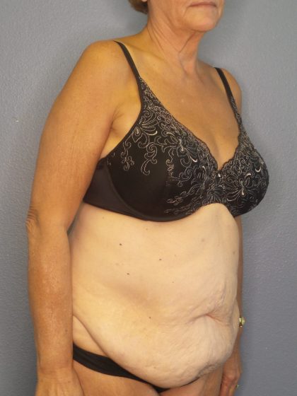 Abdominoplasty Before & After Patient #2022