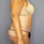 Abdominoplasty Before & After Patient #2022