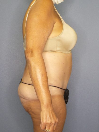 Abdominoplasty Before & After Patient #2022