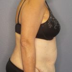 Abdominoplasty Before & After Patient #2022