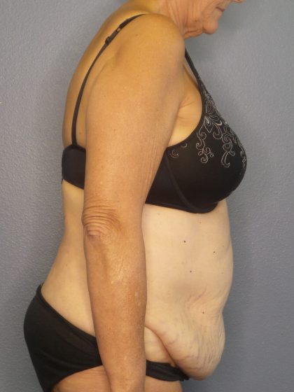 Abdominoplasty Before & After Patient #2022