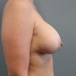 Breast Augmentation Before & After Patient #1600