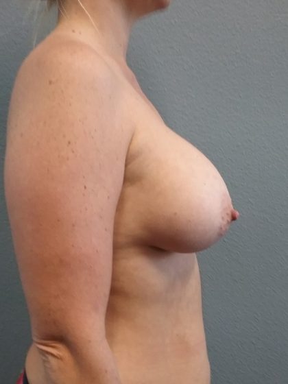Breast Augmentation Before & After Patient #1600