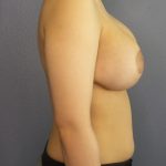 Breast Lift with Implant (Augmentation Mastopexy) Before & After Patient #976