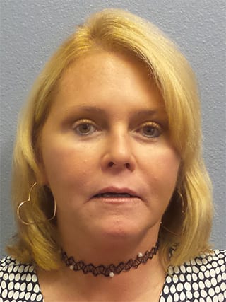 Facelift Before & After Patient #942