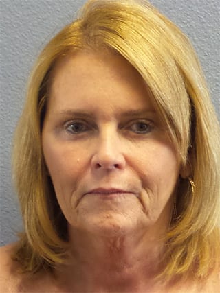 Facelift Before & After Patient #942