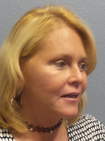 Facelift Before & After Patient #942