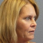 Facelift Before & After Patient #942