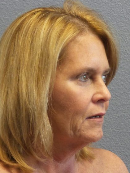Facelift Before & After Patient #942