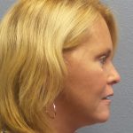 Facelift Before & After Patient #942