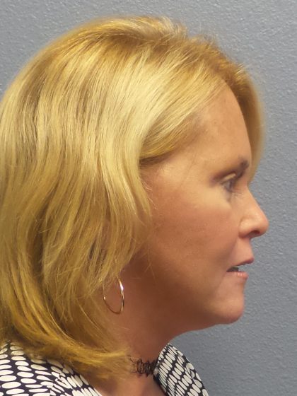 Facelift Before & After Patient #942