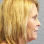 Facelift Before & After Patient #942