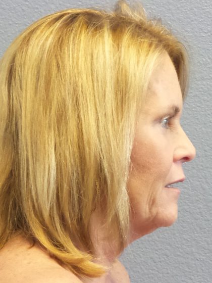 Facelift Before & After Patient #942