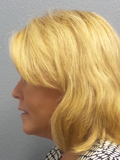 Facelift Before & After Patient #942