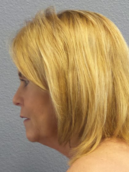 Facelift Before & After Patient #942