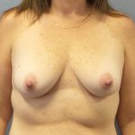 Breast Lift with Implant (Augmentation Mastopexy) Before & After Patient #998